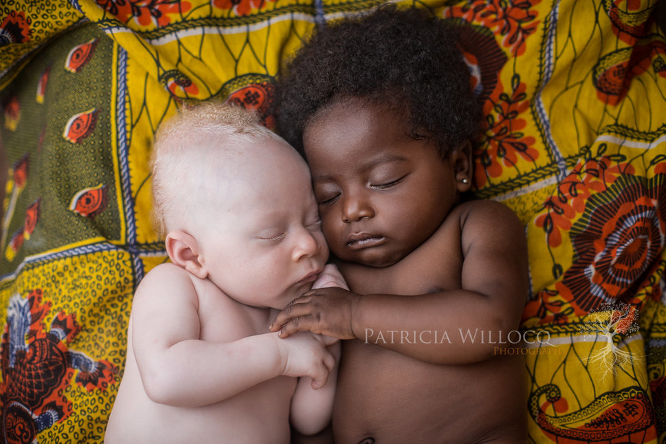 Female Photographer Fights The Stigma Of Albinism With Stunning Photo Essay